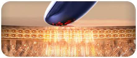 射频皮肤治疗仪(images 26)