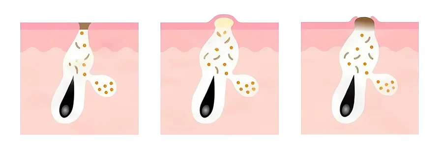 超声波铲皮机（images 10）