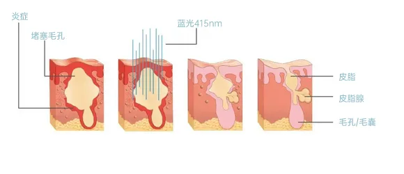 面罩美容仪(images 21)