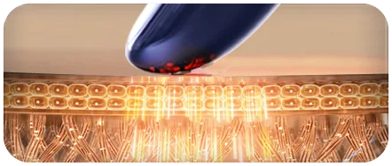 射频皮肤治疗仪（images 26）