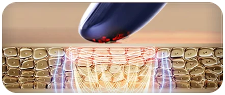 射频皮肤治疗仪（images 27）