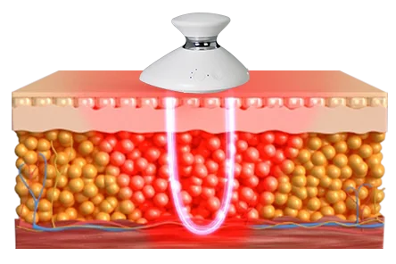 EMS纤体仪（images 10）
